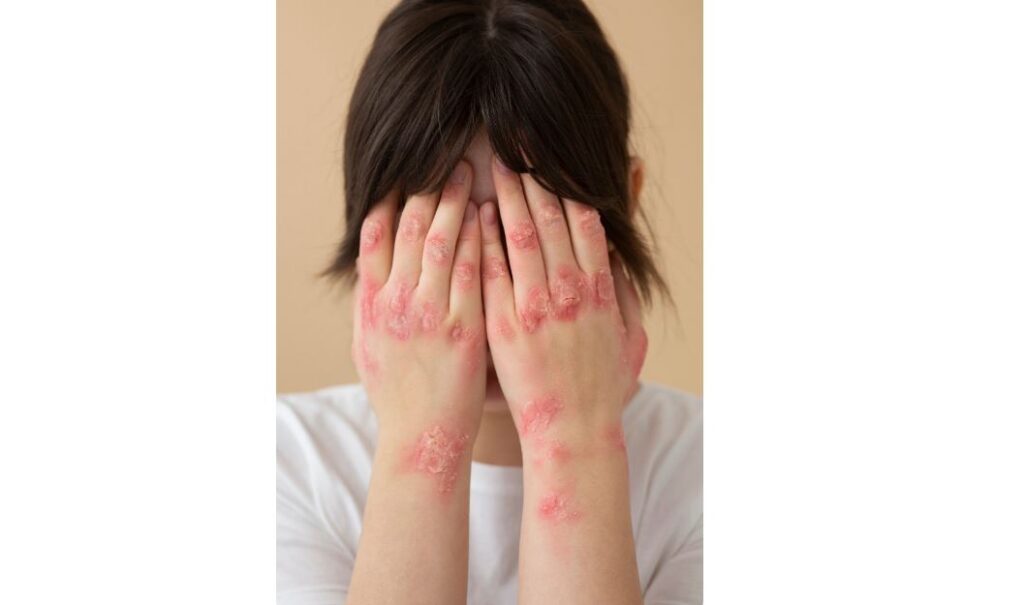 diamond skin disease human
